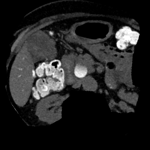 Ampullary adenocarcinoma (Radiopaedia 34013-35241 AXIAL MIPS 3-1.5 65).png