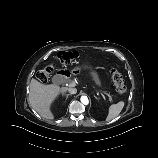 Ampullary adenocarcinoma (Radiopaedia 59373-66734 A 49).jpg
