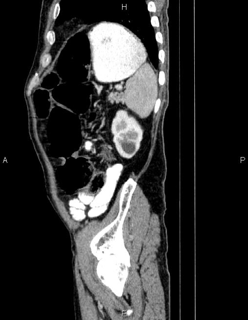 Ampullary adenocarcinoma (Radiopaedia 86093-102032 D 80).jpg