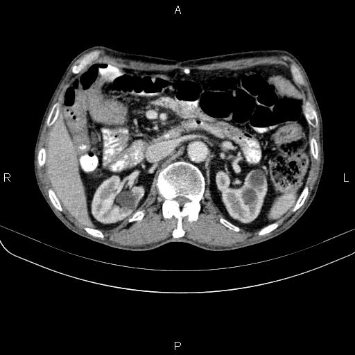 File:Ampullary adenocarcinoma (Radiopaedia 86093-102033 B 62).jpg