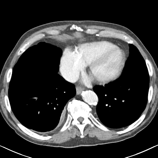 File:Amyand hernia (Radiopaedia 39300-41547 A 1).png