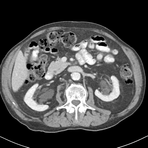 File:Amyand hernia (Radiopaedia 39300-41547 A 26).png