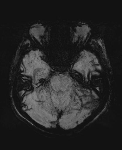 File:Amyloid angiopathy with inflammation (Radiopaedia 30360-31002 Axial SWI MIP 12).jpg