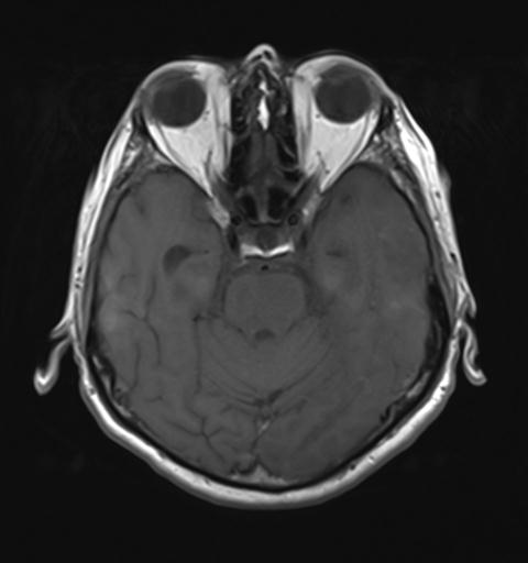 File:Amyloid angiopathy with inflammation (Radiopaedia 30360-31002 Axial T1 11).jpg