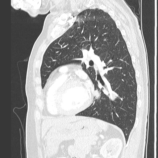 Amyloidosis - bronchial and diffuse nodular pulmonary involvement (Radiopaedia 60156-67745 Sagittal lung window 60).jpg