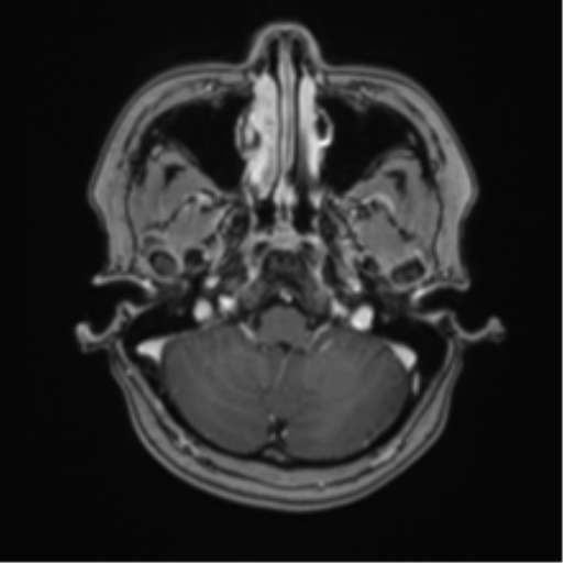 Anaplastic astroblastoma (Radiopaedia 55666-62194 Axial T1 C+ 14).png