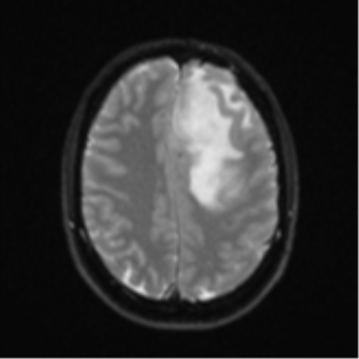 Anaplastic astrocytoma (Radiopaedia 57768-64731 Axial DWI 21).png