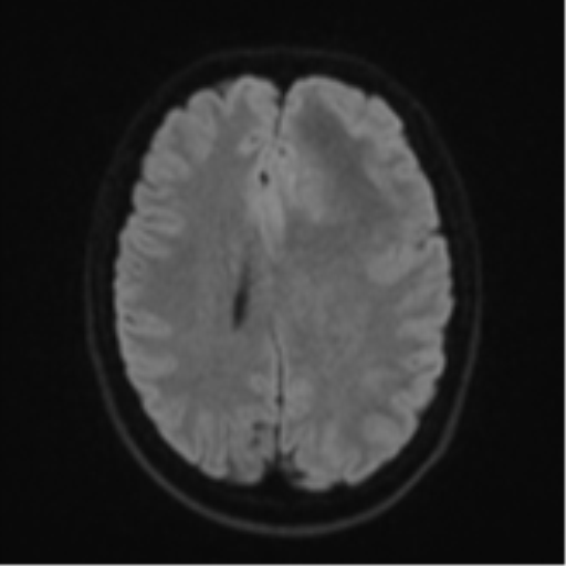 Anaplastic astrocytoma (Radiopaedia 57768-64731 Axial DWI 46).png