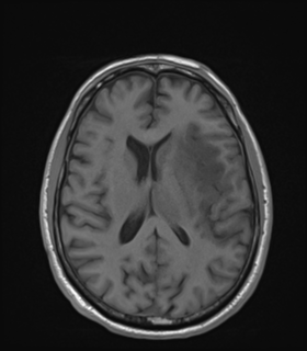 Anaplastic astrocytoma IDH wild-type (Radiopaedia 49984-55273 Axial T1 34).png