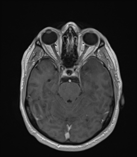 Anaplastic astrocytoma IDH wild-type (Radiopaedia 49984-55273 Axial T1 C+ 21).png