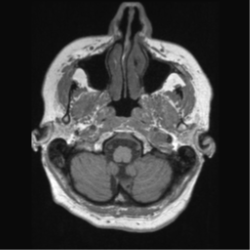 Anaplastic astrocytoma IDH wild-type (pseudoprogression) (Radiopaedia 42209-45276 Axial T1 24).png