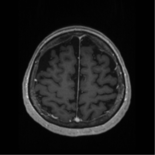 File:Anaplastic astrocytoma IDH wild-type (pseudoprogression) (Radiopaedia 42209-45276 Axial T1 C+ 116).png
