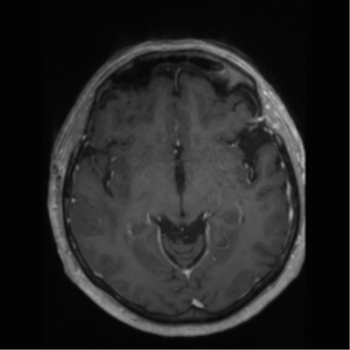 File:Anaplastic astrocytoma IDH wild-type (pseudoprogression) (Radiopaedia 42209-45277 Axial T1 C+ 54).png