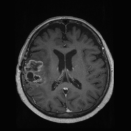File:Anaplastic astrocytoma IDH wild-type (pseudoprogression) (Radiopaedia 42209-45278 Axial T1 C+ 92).png