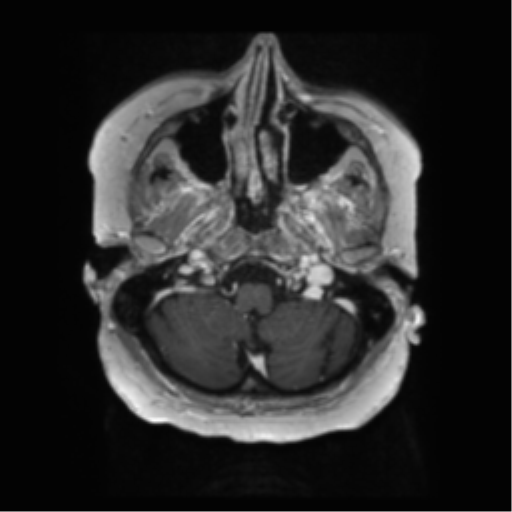 File:Anaplastic astrocytoma IDH wild-type (pseudoprogression) (Radiopaedia 42209-45279 Axial T1 C+ 24).png