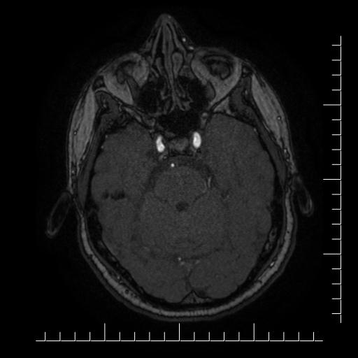 Aneurysm of posterior communicating artery (Radiopaedia 20188-20163 Axial MRA 43).jpg