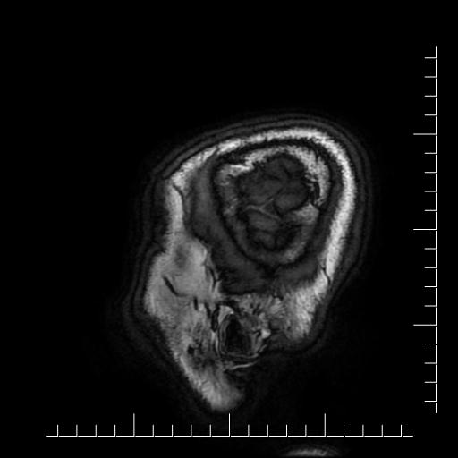 Aneurysm of posterior communicating artery (Radiopaedia 20188-20163 Sagittal T1 2).jpg