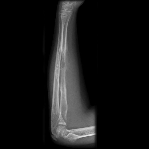 File:Aneurysmal bone cyst - radius (Radiopaedia 5866-7440 Lateral 1).jpg