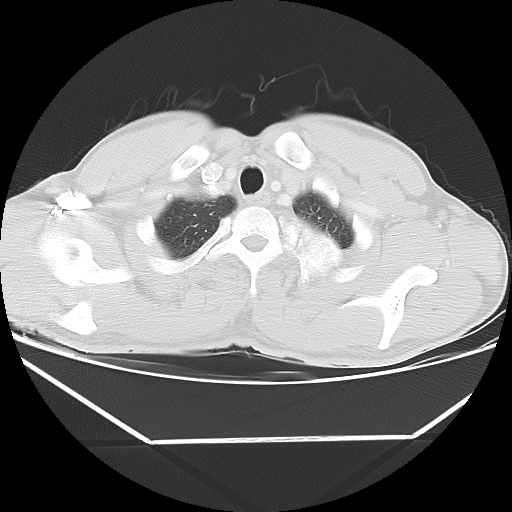 File:Aneurysmal bone cyst - rib (Radiopaedia 82167-96220 Axial lung window 14).jpg