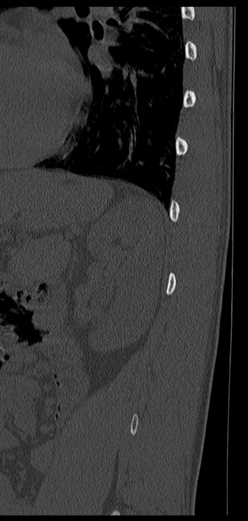 Aneurysmal bone cyst T11 (Radiopaedia 29294-29721 Sagittal bone window 7).jpg