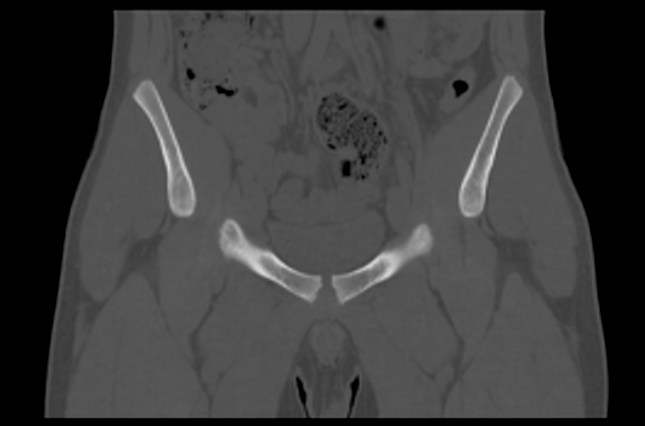 File:Aneurysmal bone cyst of ischium (Radiopaedia 25957-26094 Coronal bone window 11).png
