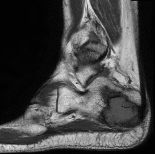 File:Aneurysmal bone cyst of the calcaneus (Radiopaedia 60669-68420 Sagittal T1 5).jpg