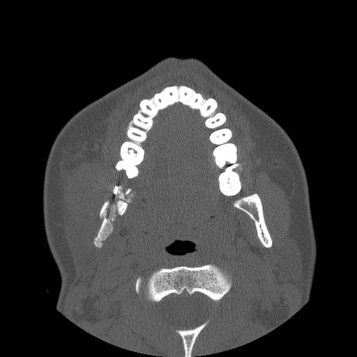 Aneurysmal bone cyst of the mandible (Radiopaedia 43280-46823 Axial bone window 73).jpg