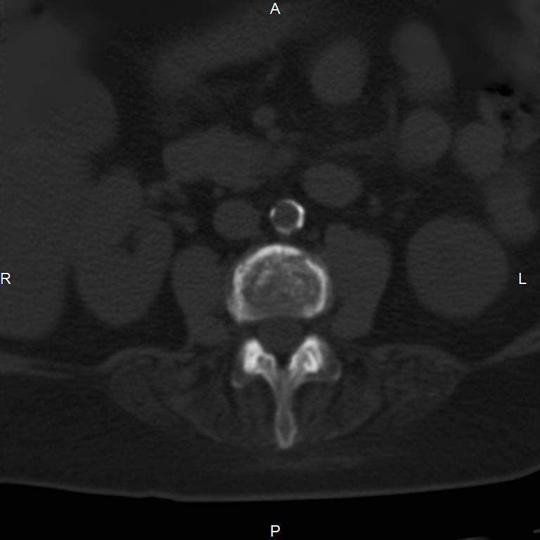 Ankylosing spondylitis (Radiopaedia 8748-9556 Axial bone window 30).jpg