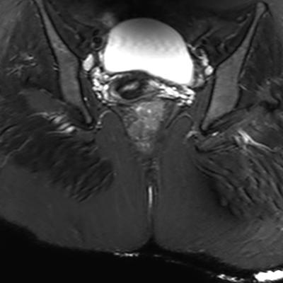 File:Ano-vaginal fistula (Radiopaedia 29765-30284 Coronal STIR 16).jpg