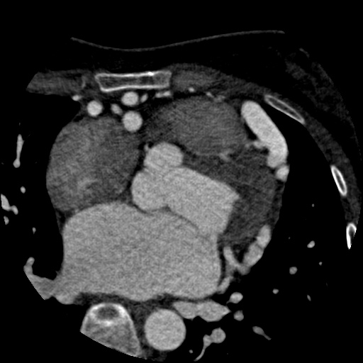 Anomalous left coronary artery from the pulmonary artery (ALCAPA) (Radiopaedia 40884-43586 A 32).jpg