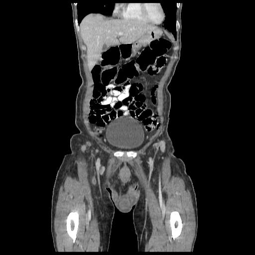 Anorectal carcinoma (Radiopaedia 44413-48064 B 7).jpg
