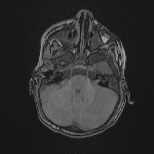 File:Anoxic brain injury (Radiopaedia 79165-92139 Axial MRA 52).jpg