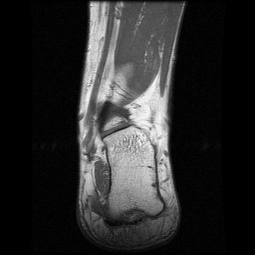 File:Anterior calcaneal process fracture (Radiopaedia 74654-85611 Coronal T1 19).jpg