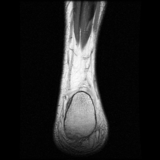 File:Anterior calcaneal process fracture (Radiopaedia 74654-85611 Coronal T1 25).jpg