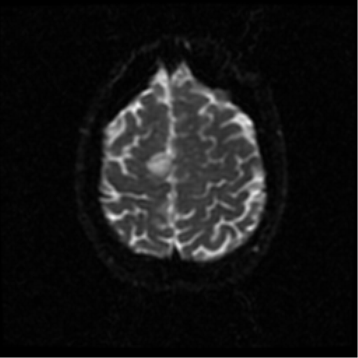 File:Anterior cerebral artery territory infarct (Radiopaedia 39327-41584 Axial DWI 47).png
