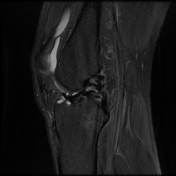 File:Anterior cruciate ligament graft tear and bucket-handle tear of medial meniscus (Radiopaedia 75867-87254 Sagittal PD fat sat 14).jpg