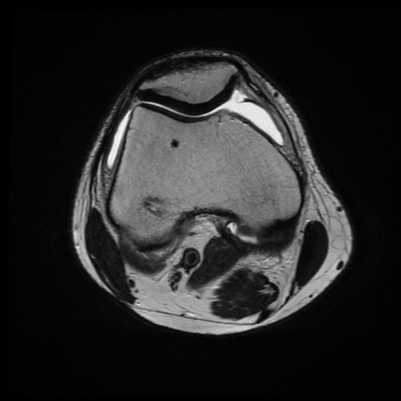 File:Anterior cruciate ligament graft tear and bucket-handle tear of medial meniscus (Radiopaedia 75867-87255 Axial T2 17).jpg