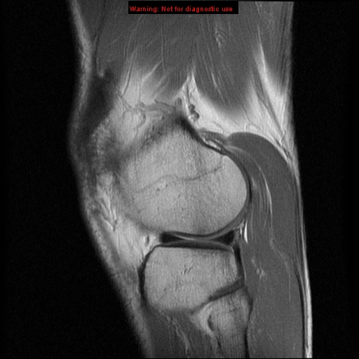 File:Anterior cruciate ligament injury - partial thickness tear (Radiopaedia 12176-12515 Sagittal PD 15).jpg