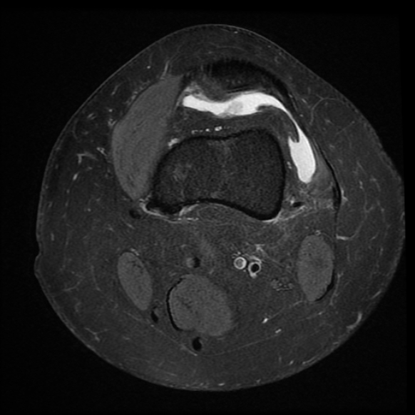 File:Anterior cruciate ligament tear, Wrisberg rip and bucket-handle tear of medial meniscus (Radiopaedia 75872-87266 Axial PD fat sat 24).jpg