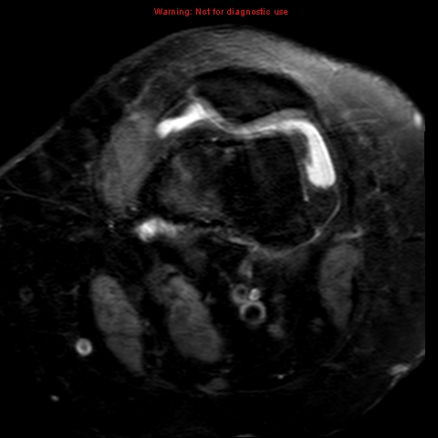 File:Anterior cruciate ligament tear (Radiopaedia 12329-12612 Axial T2 fat sat 18).jpg