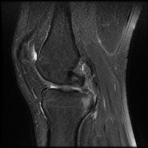 File:Anterior cruciate ligament tear with posteromedial corner injury, bucket-handle meniscal tear and chondral delamination (Radiopaedia 75501-86744 Sagittal PD fat sat 11).jpg