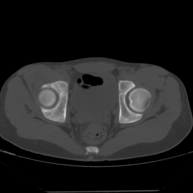 Anterior inferior iliac spine avulsion fracture (Radiopaedia 49469-54627 Axial bone window 37).jpg