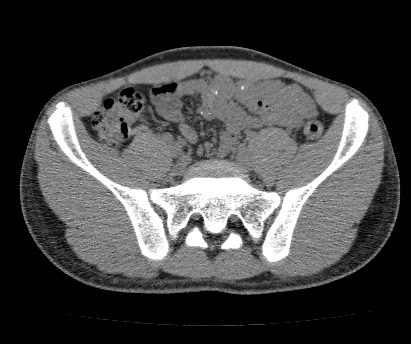 File:Anterior inferior iliac spine avulsion fracture (Radiopaedia 81312-94999 Axial non-contrast 27).jpg