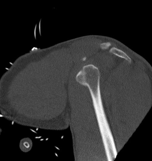 Anterior shoulder dislocation with Hill-Sachs and bony Bankart lesions (Radiopaedia 40424-42974 Sagittal bone window 17).png