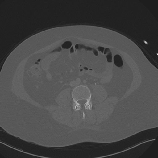 Anterior superior iliac spine avulsion fracture (Radiopaedia 44541-48244 Axial bone window 59).png