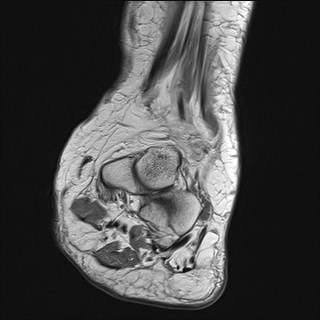File:Anterior talofibular ligament injury - rupture with soft-tissue impingement (Radiopaedia 38765-40928 Coronal PD 23).jpg