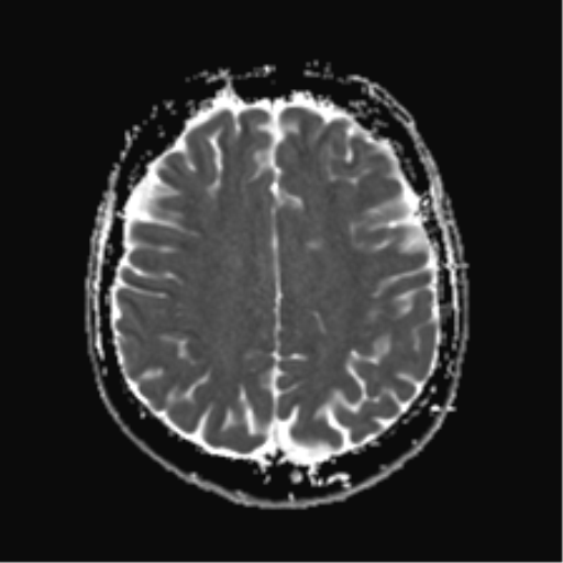 File:Anterior temporal lobe perivascular space (Radiopaedia 40946-43650 Axial ADC 19).png