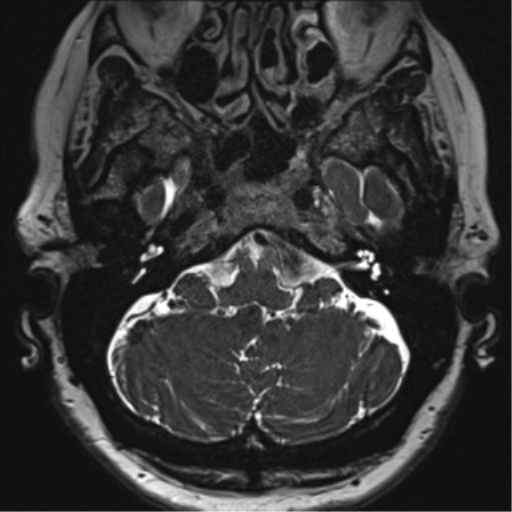 File:Anterior temporal pole cysts (Radiopaedia 46629-51102 Axial T2 25).png