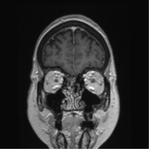 Anterior temporal pole cysts (Radiopaedia 46629-51102 Coronal T1 C+ 144).png