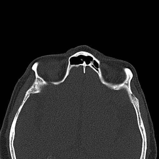 Antral exostoses (Radiopaedia 22371-22396 Axial bone window 41).jpg